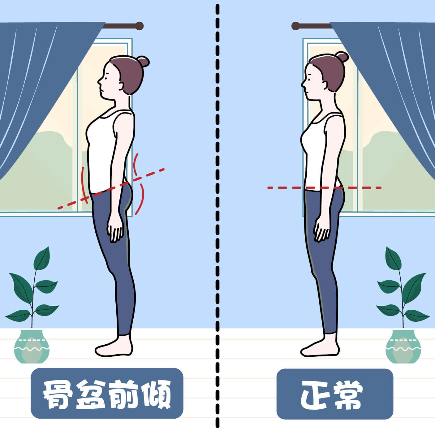 什麼是骨盆前傾